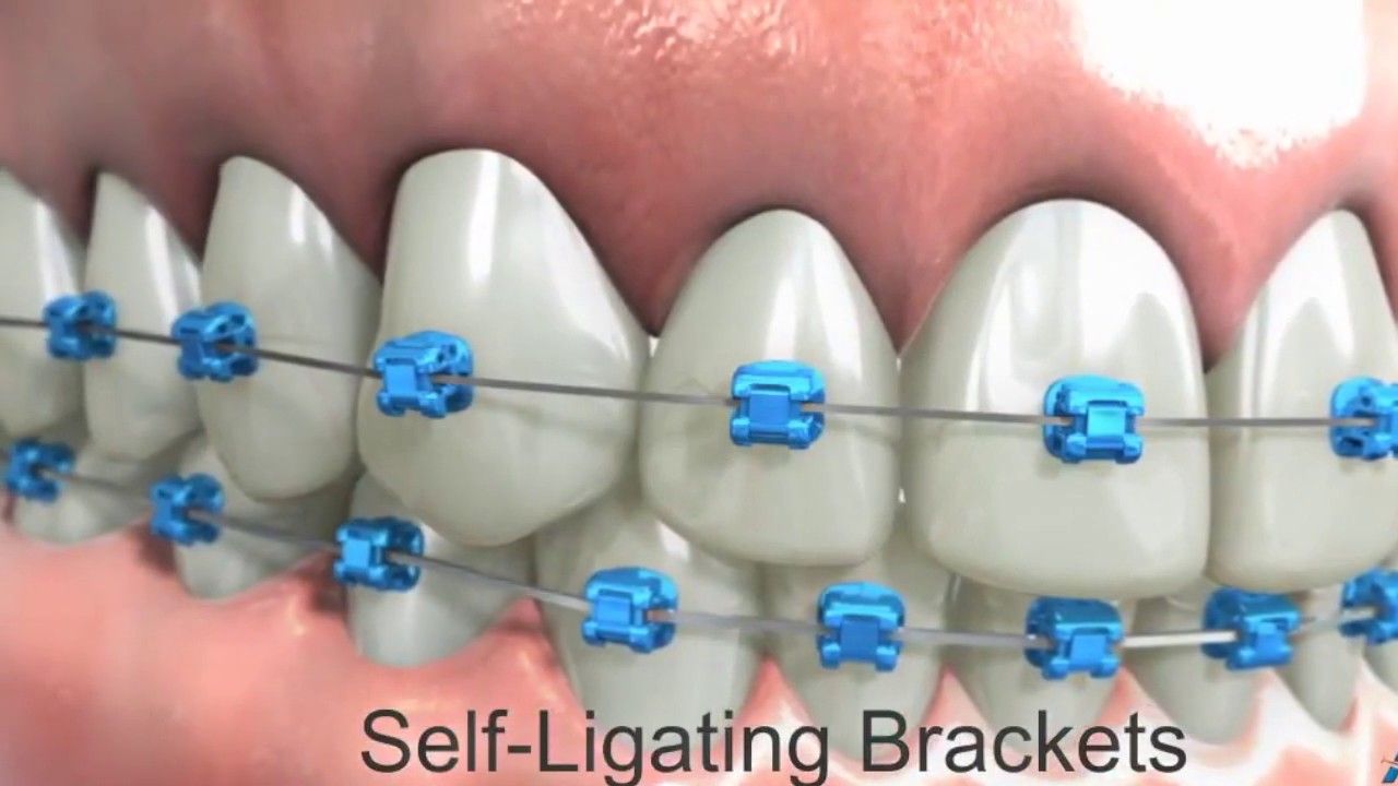 En Espanol   Starting Your Braces Journey With Hello Ortho