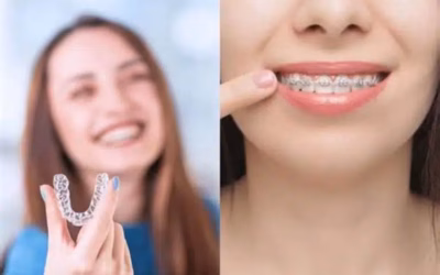 Clear Braces vs. Metal Braces